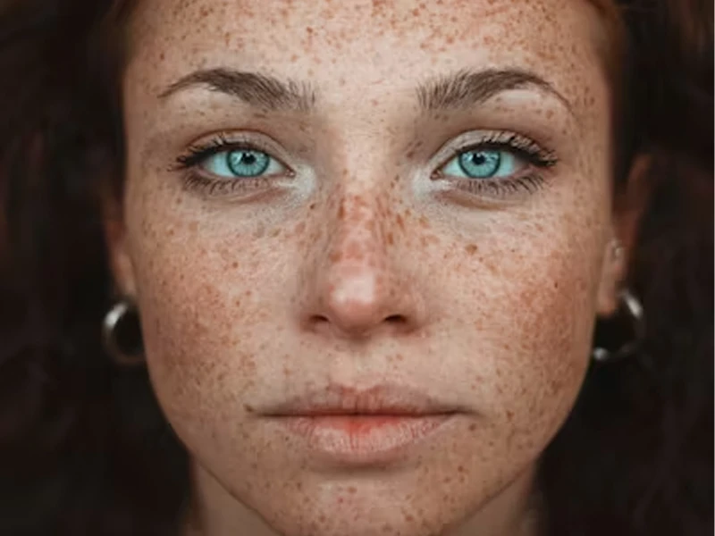 رفع کک و مک؛ راهی برای داشتن پوستی صاف و روشن تر 