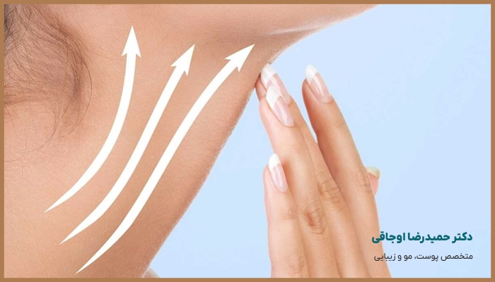 ماندگاری اندولیفت گردن چقدر است؟
