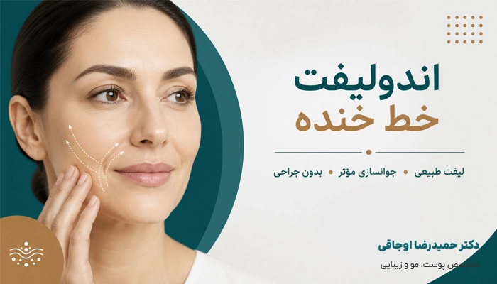 اندولیفت خط خنده برای چه کسانی مناسب است؟