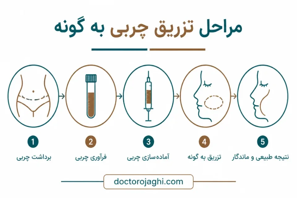نمای توضیحی درباره تزریق چربی به گونهها